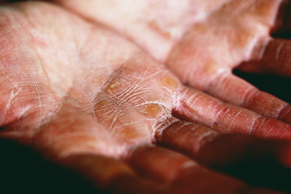 10 Skin Care Tips for Dry Skin: Relieve Your Dry Skin