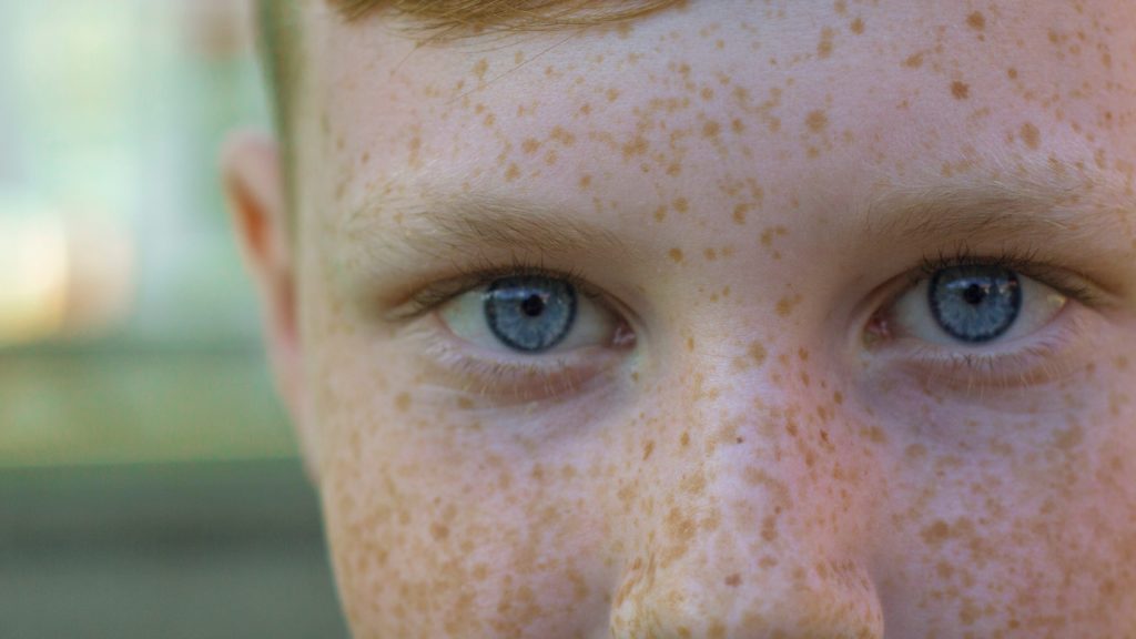 Best Hacks To Get Rid Of Body Acne For Men