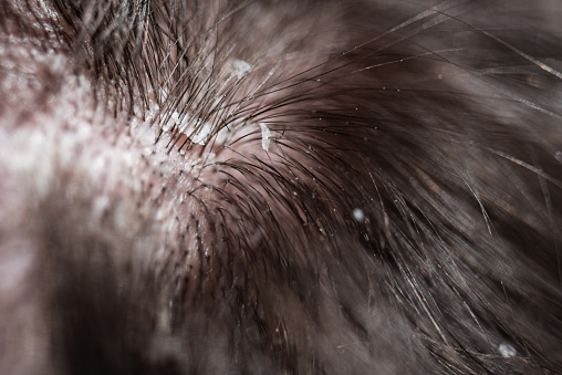 What is dandruff?