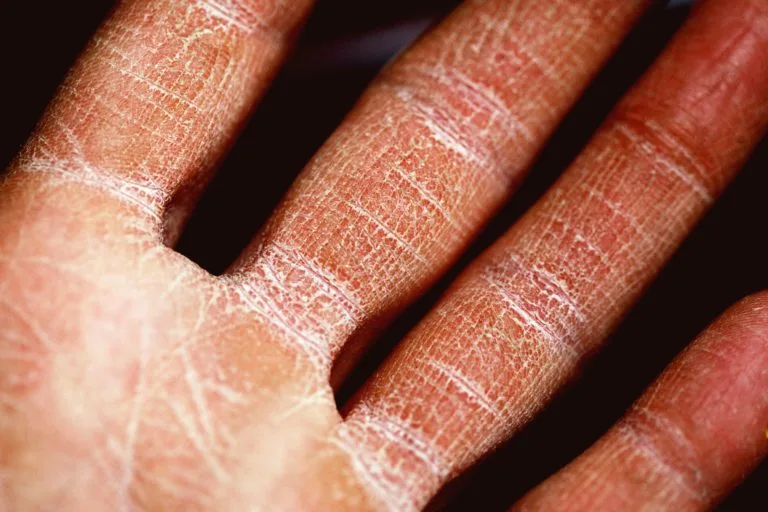 Plastic Surgery What Causes an Eczema Flare-Up in the Winter