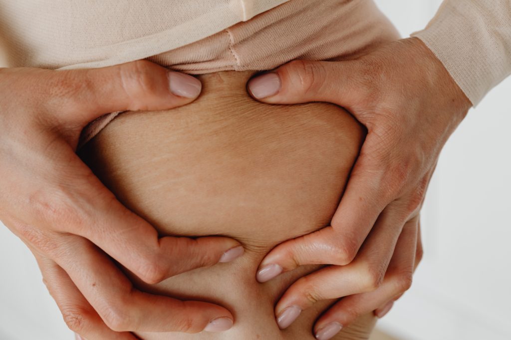 What Causes Stretch Marks and How You Can Prevent Them