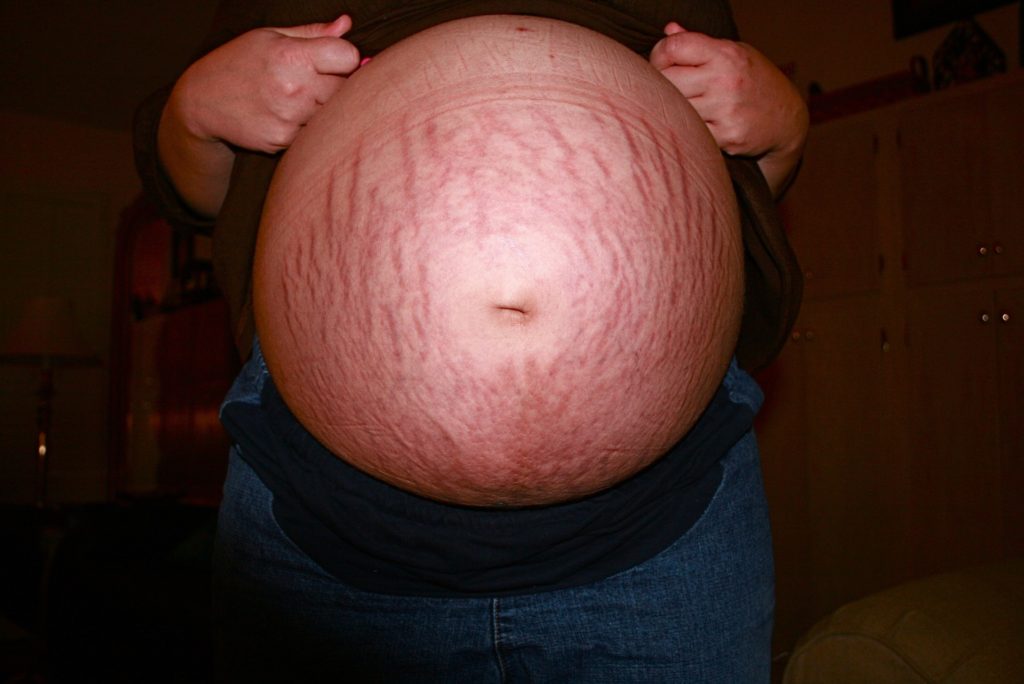 8 Tips to Correctly Exfoliate Your Stretch Marks