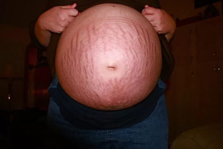 Journaling 8 Tips to Correctly Exfoliate Your Stretch Marks