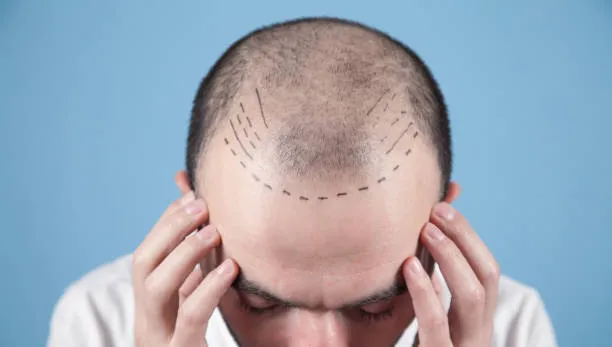 regrow hair on a bald spot Hair regrowth