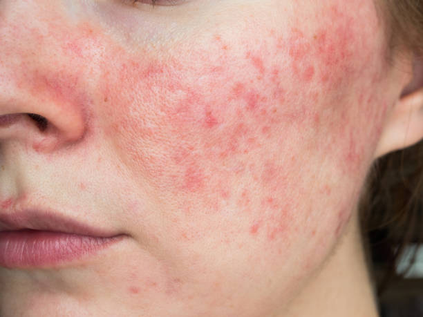 How to Treat Rosacea at Home