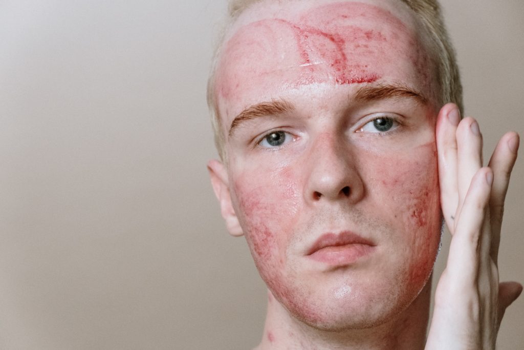 A Food Intolerance May Be the Cause of Your Acne