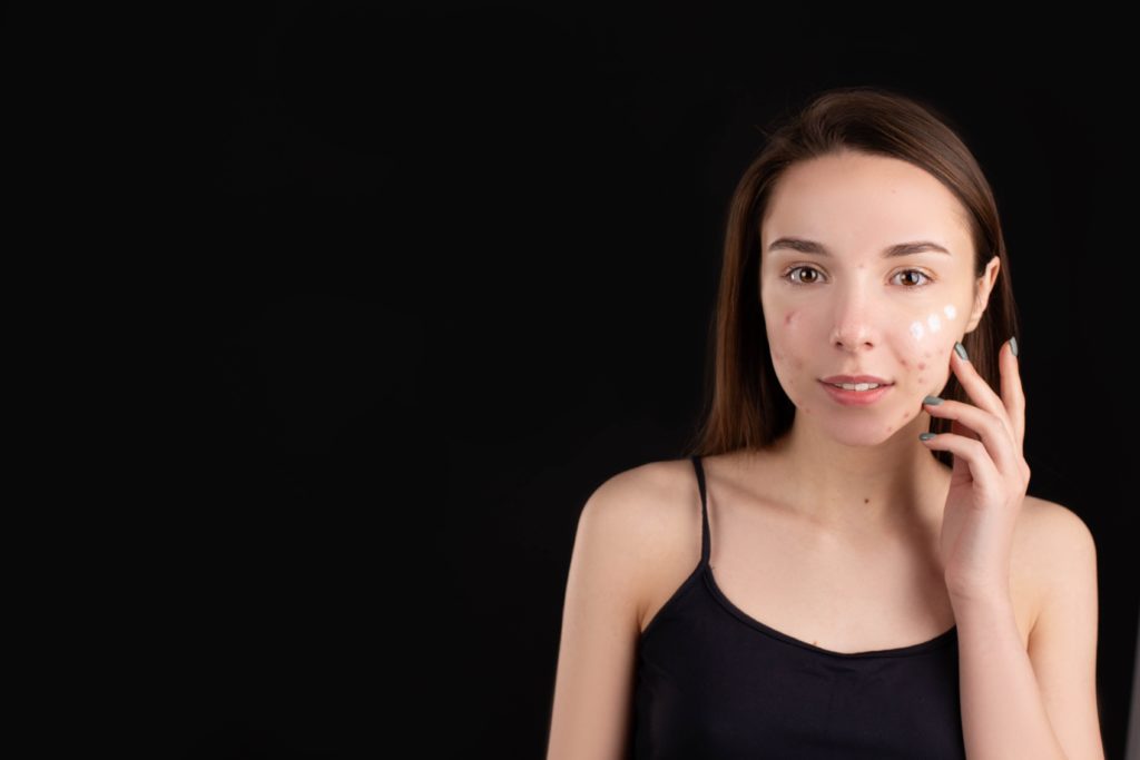 Which Vitamin A Should You Use For Acne-Prone Skin?