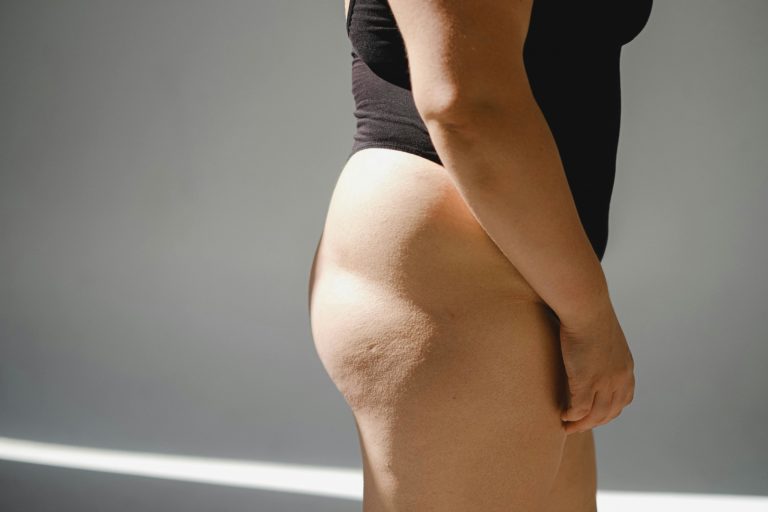 Buttock Acne – Causes And Treatment Options