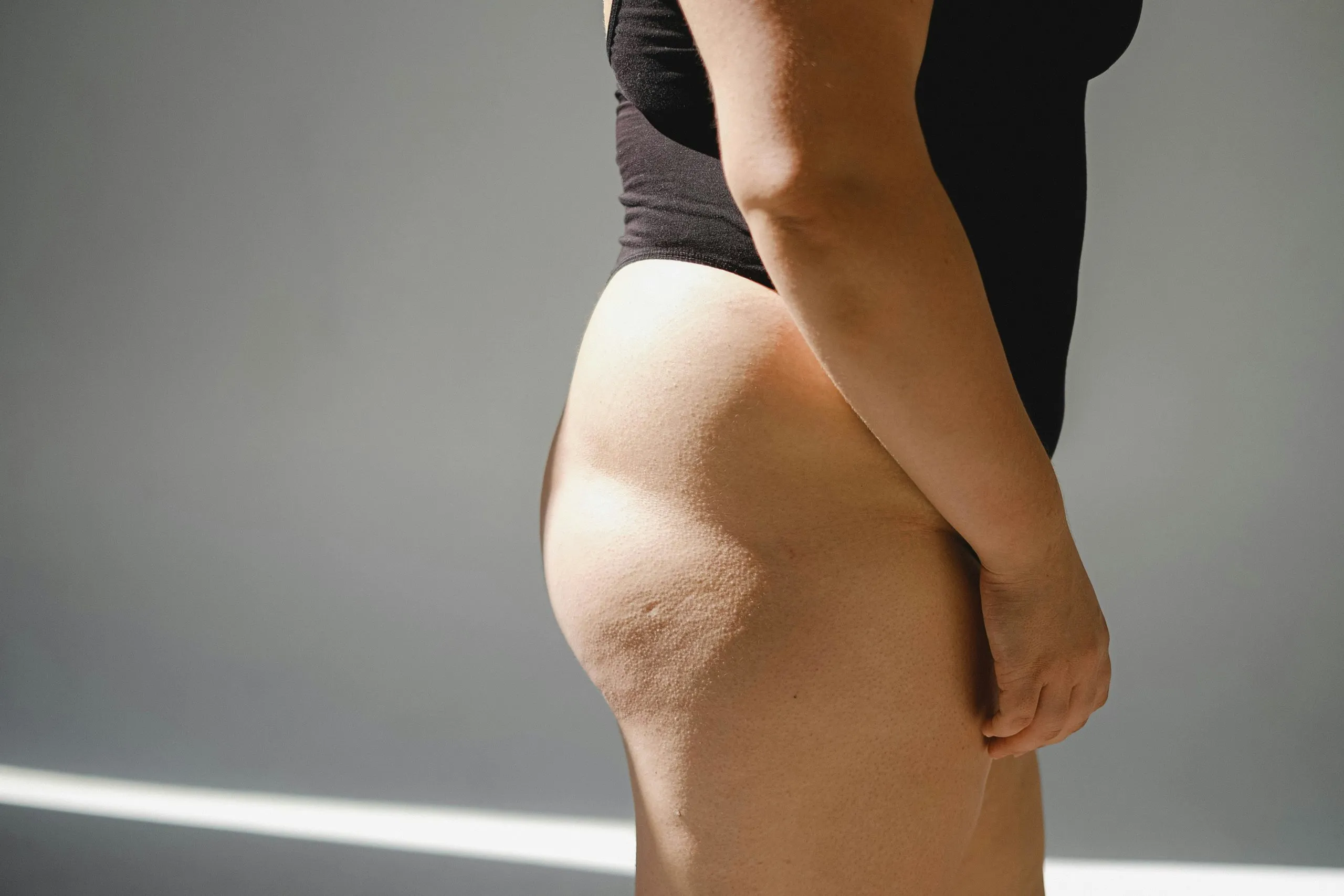 Buttock Acne – Causes And Treatment Options