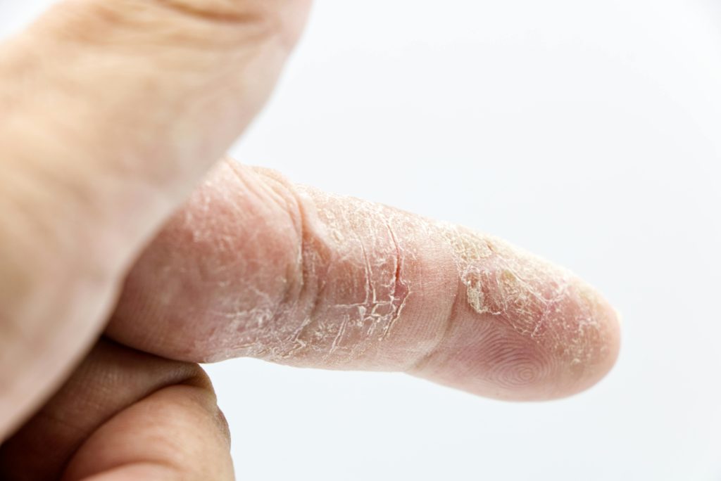 Ways To Prevent Your Skin From Purging