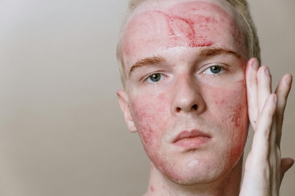 DIY Natural Eczema Treatments for Soothing Relief