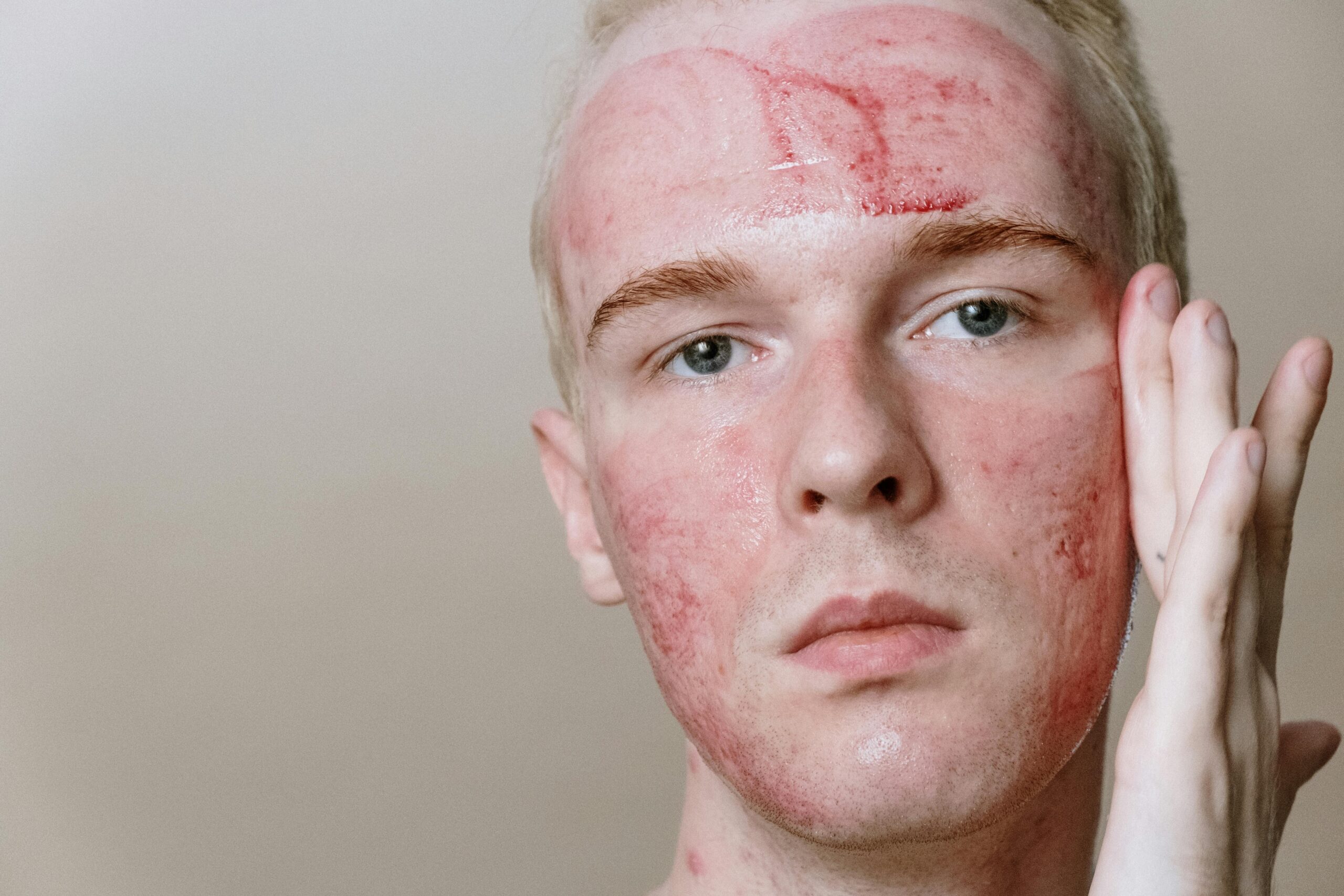 DIY Natural Eczema Treatments for Soothing Relief