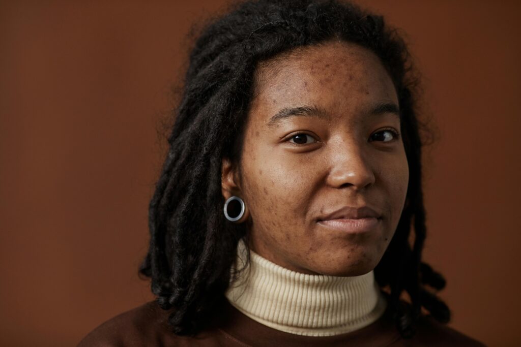 Understanding the Different Types of Acne and How to Treat Them