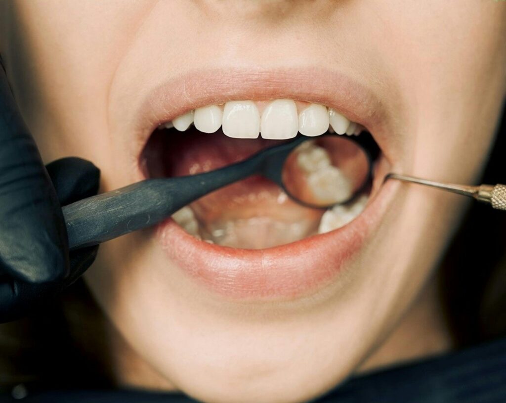 Natural Remedies for Tooth Sensitivity: Soothing Irritation and Discomfort