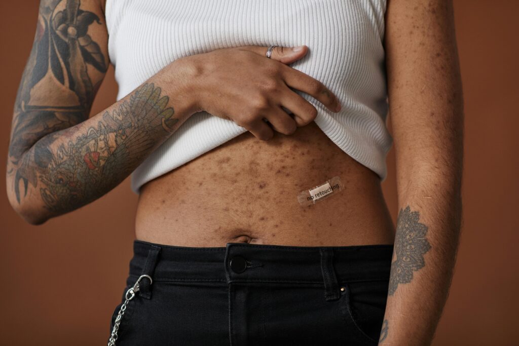 Body Acne Solutions: Treating and Preventing Breakouts on Body
