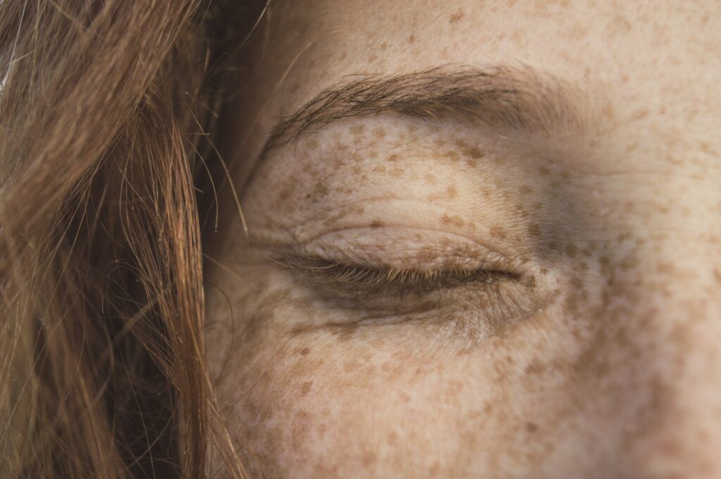 DIY Natural Remedies for Rosacea and Redness