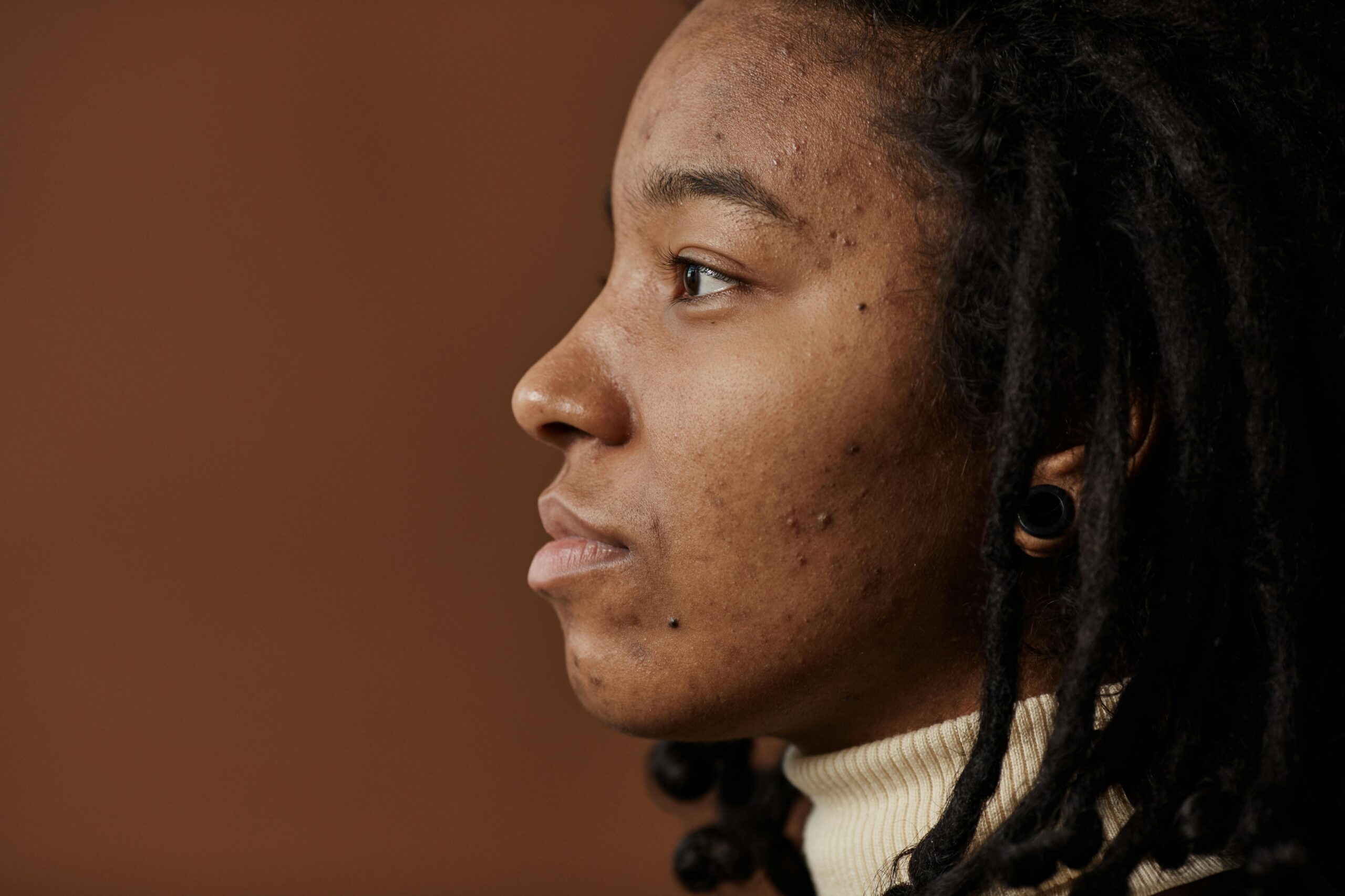 DIY Natural Remedies for Acne Scarring and Hyperpigmentation
