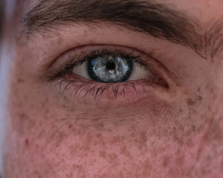 How to Treat Hyperpigmentation Naturally and Effectively